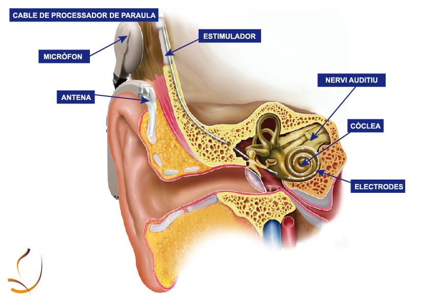 Esquema d'un implant coclear amb etiquetes en català per entendre les seves parts.